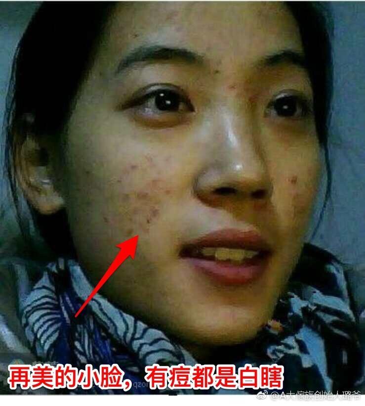 痘印怎么去,试试赵丽颖拍戏常用的痘印精华!痘