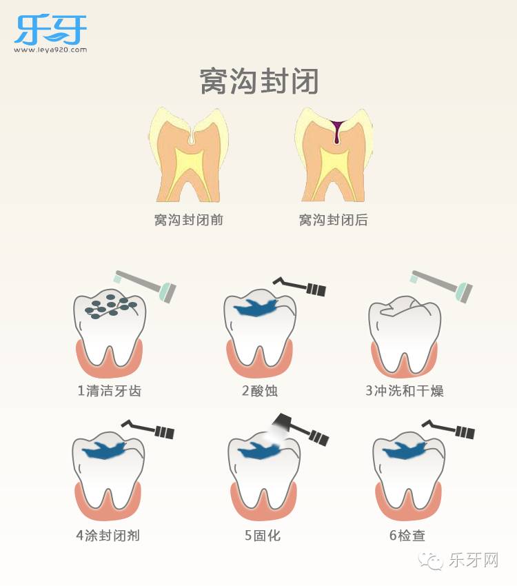 窝沟封闭技术分为六个步骤分别是