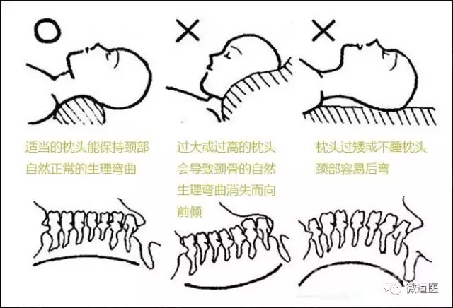 然后产生骨质增生或椎间盘突出,导致神经血管压迫造成颈椎病