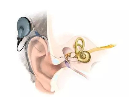 0岁到100岁都要听力健康,人工耳蜗植入并非聋