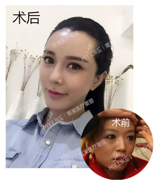 想要自然美鼻style? 不想隆鼻走冤枉路? 看看人家是怎么隆鼻的! 张雪儿 回看以前的照片 真的有种丑到不忍直视的感觉 现在还有很多初涉整形的朋友问我 「怎么鼓起勇气去整」▼ 很简单:长得不好看,想美 在看脸的世界,长得好看浑身都是优势 隆鼻前,我也是做了很多功课 小机构小医院不考虑,担心风险 韩国坚决不去,沟通是个大问题 选择美莱是因为大机构,口碑好,够专业够权威 我做的是综合隆鼻 之前担心做出来会假 但医生的专业打消了我的顾虑 他们把隆鼻做得很细致,例如