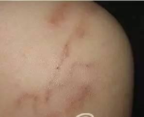 男子吞下4条野猪胃里的寄生虫！一条已取出，还有三条未找到