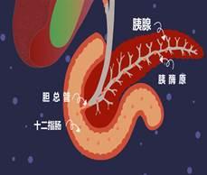 不吃早饭、晚上酒肉吃喝……小心胰腺炎找上你!