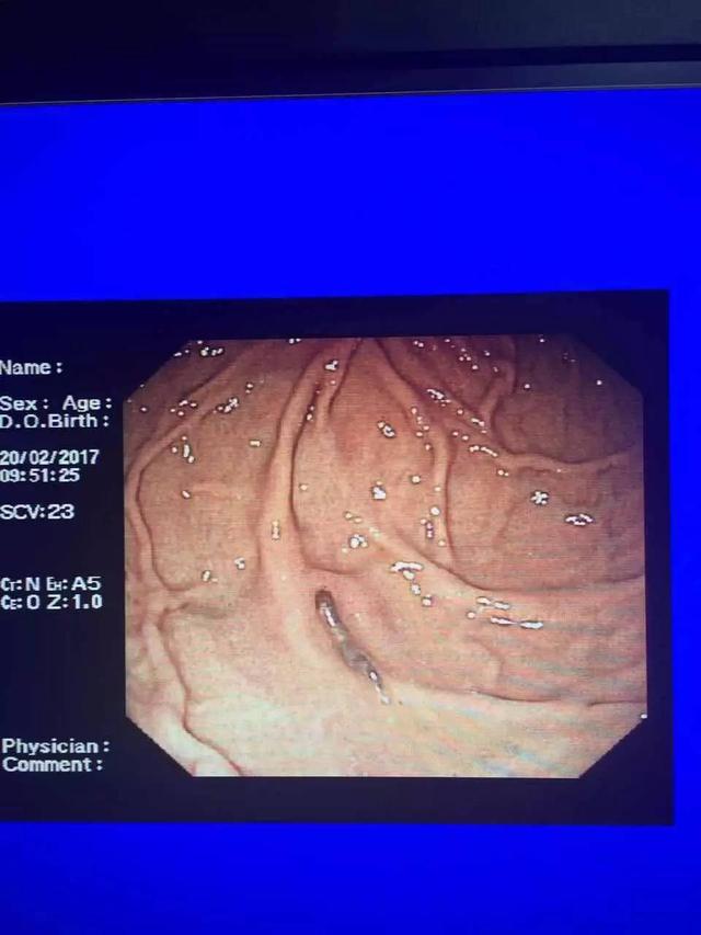男子吞下4条野猪胃里的寄生虫！一条已取出，还有三条未找到