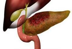 不吃早饭、晚上酒肉吃喝……小心胰腺炎找上你!