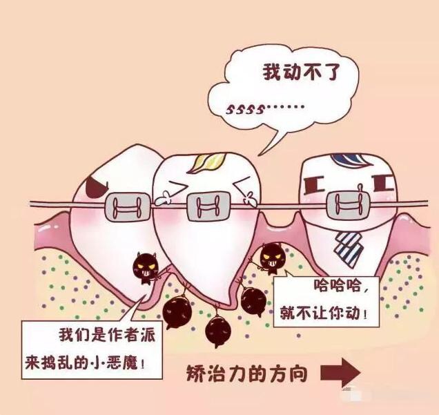 牙齿矫正真的会让牙齿松动么?