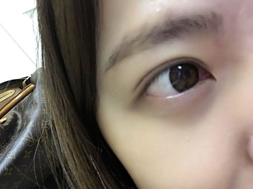 (术后2年)双眼皮全切 开内眼角 去脂去皮 上眼睑提升手术