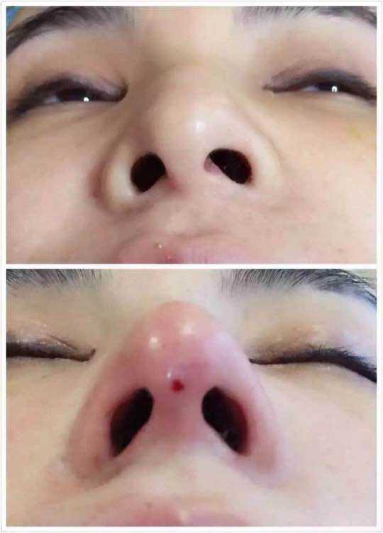 线雕隆鼻是将蛋白线写入鼻部