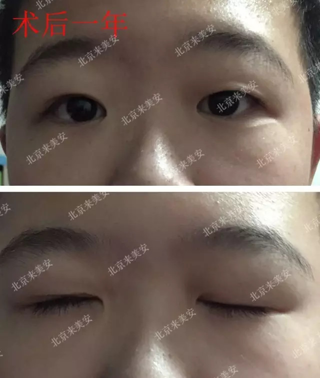 11岁小帅哥#上睑下垂# 术后一年变化有多大?