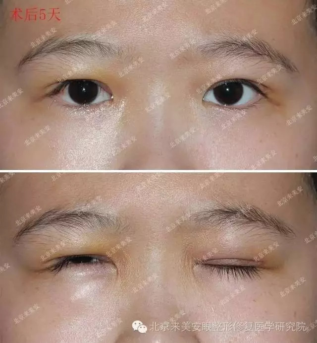 11岁小帅哥#上睑下垂# 术后一年变化有多大?