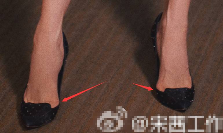 宋茜经常踩着恨天高跳舞外翻严重的大脚趾真惹人心疼