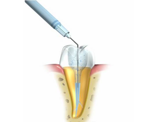 根管治疗成功的九大要素