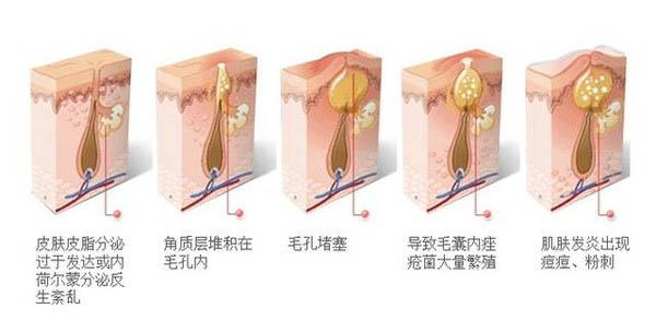 被坑的“战痘”英雄，你是其中一个吗？