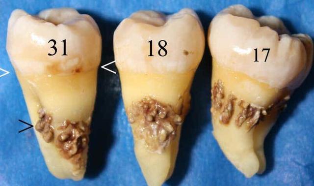 牙结石早期图片图片
