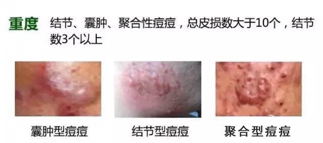 被坑的“战痘”英雄，你是其中一个吗？