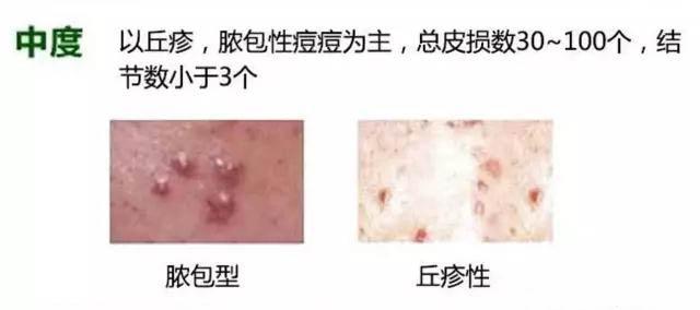 被坑的“战痘”英雄，你是其中一个吗？