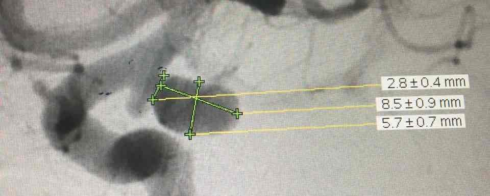 CTA&DSA谁能更准确发现脑动脉瘤?