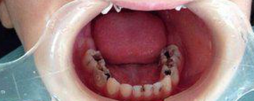 三岁孩子从不吃糖却满嘴烂牙,父母到诊所补牙才发现自己无知