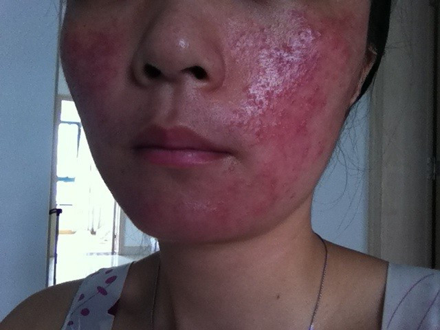 激素脸怎么办,给我5分钟告诉你(原创)