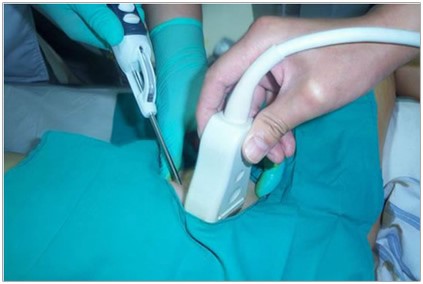 乳腺真空辅助旋切术是在局麻下,借助b超或者x线立体