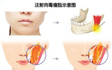瘦脸针注射原理示意图