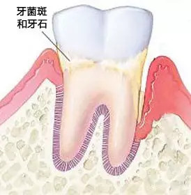 “龋齿也要检查，避免孕前没补牙，可能会发展成深龋或急性牙髓炎 ，而且如果准妈妈有蛀牙，宝宝患蛀牙的可能性也很大。”