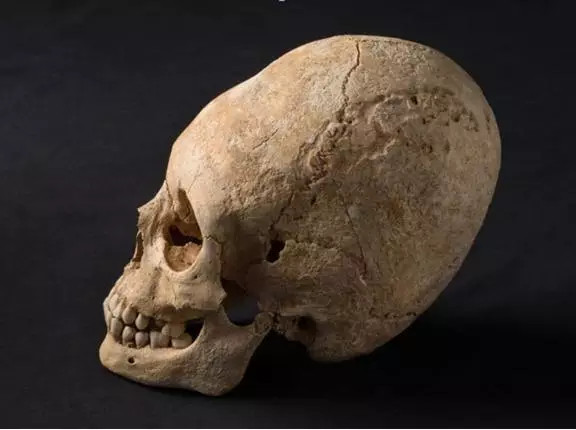 出土的匈人颅骨,有明显的缠头导致的畸形