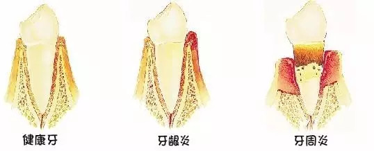 另外，我们在长智齿的时候，智齿的周围就特别容易发炎，像这种就属于冠周炎