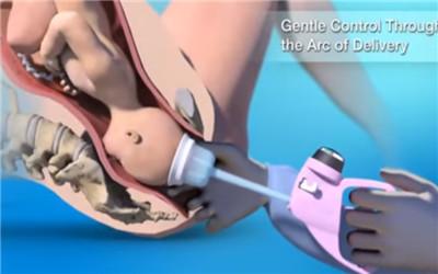 顺产时难产 被医生用吸引器把胎儿吸出来 太令人心疼了 附图