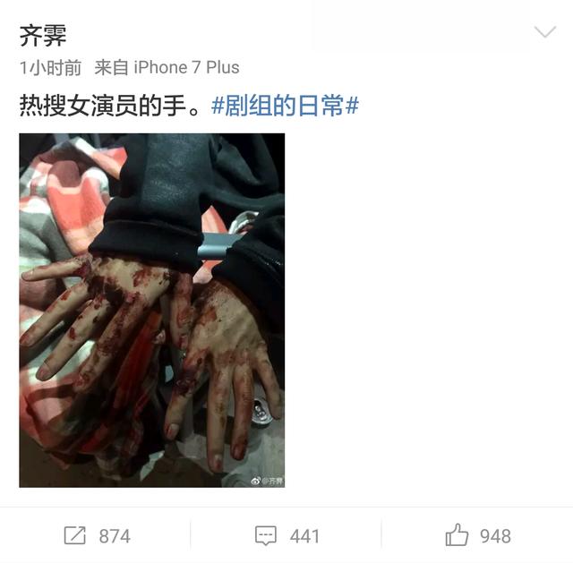 杨幂受伤业内人士晒杨幂拍戏受伤照这就是热搜女演员的手